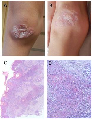 Prospective Study of a Cohort of Russian Nijmegen Breakage Syndrome Patients Demonstrating Predictive Value of Low Kappa-Deleting Recombination Excision Circle (KREC) Numbers and Beneficial Effect of Hematopoietic Stem Cell Transplantation (HSCT)